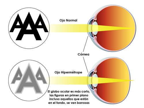 hipermetropía en niños es normal ochi inrositi si durerosi